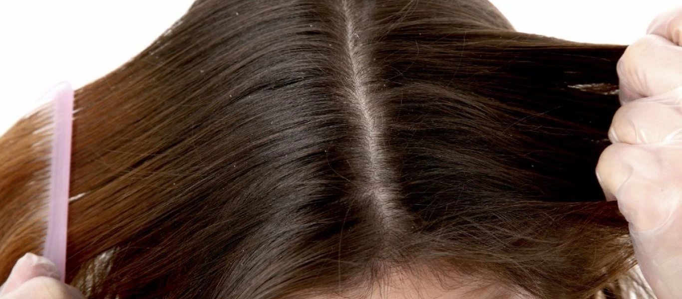 Πώς να εξαφανίσετε την πιτυρίδα με πέντε σπιτικά υλικά